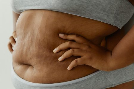 Stretch marks Stretch marks